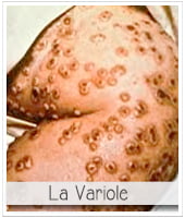 vesicules pustules de variole pour illustrer l'article PCPL traitant du vaccin de la petite verole à partir de cow pox par edward jenner